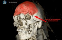 Тагильские врачи спасли мужчину с раздробленным черепом после ДТП