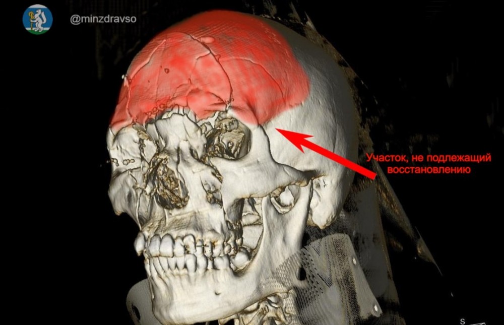 Тагильские врачи спасли мужчину с раздробленным черепом после ДТП