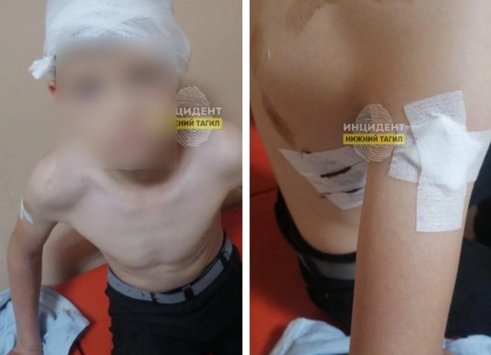 Под Нижним Тагилом бойцовская собака набросилась на гуляющего ребёнка, её хозяйка даже не оказала помощь